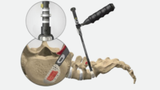 Coroent TLIF Anterior Ti