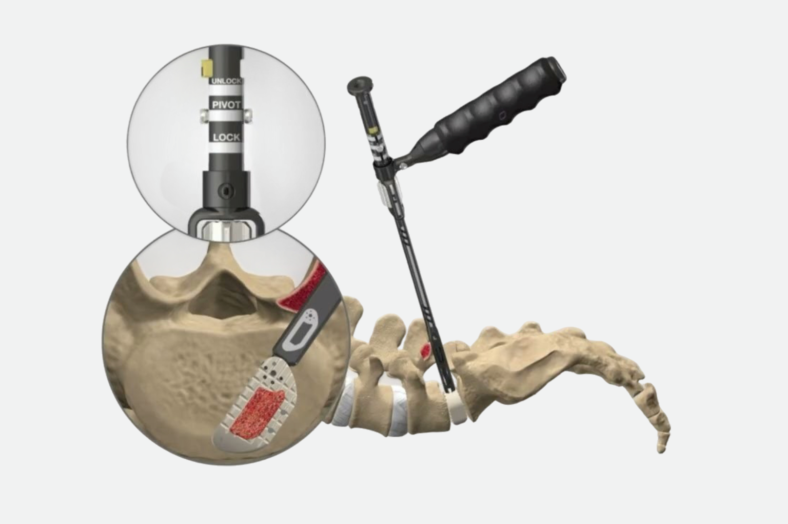 Coroent TLIF Anterior Ti