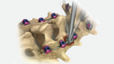 Reline Adjacent Segment Fixation