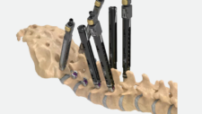 Reline Fenestrated